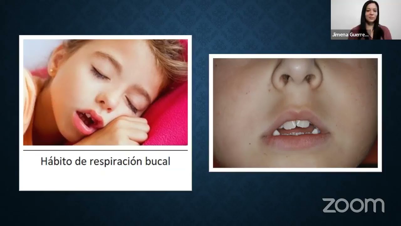 Maloclusiones en niños