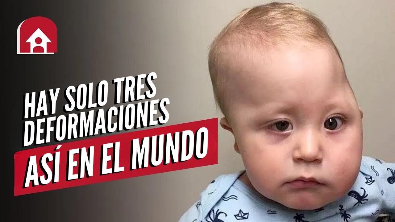 Mi hijo tiene una deformidad en el cráneo: Tania | Ser mamá