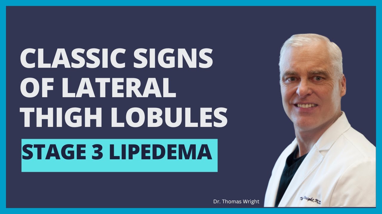 Dr. Wright shows the  classic signs - Lipedema