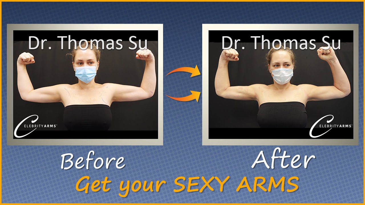 Lipo 360&deg; Arms | Arm Liposuction Immediate Results | Celebrity Arms&trade; | Expert Dr. Thomas Su