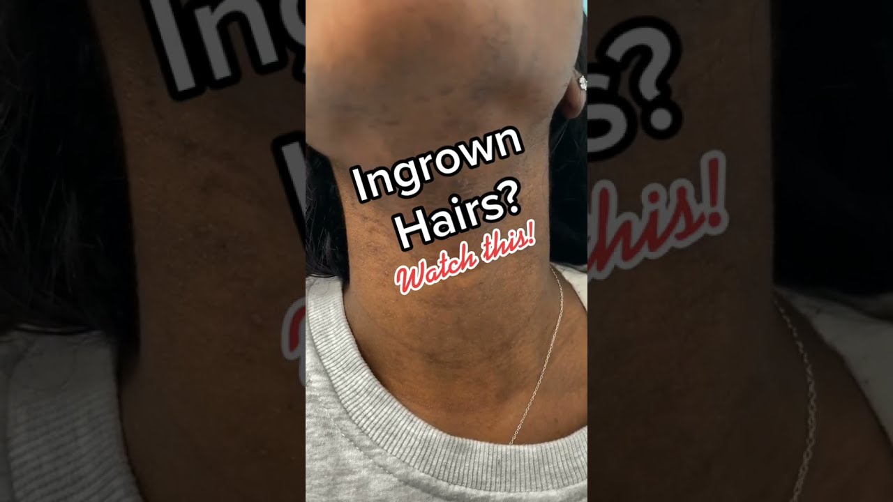 How to treat Ingrown hairs #shorts