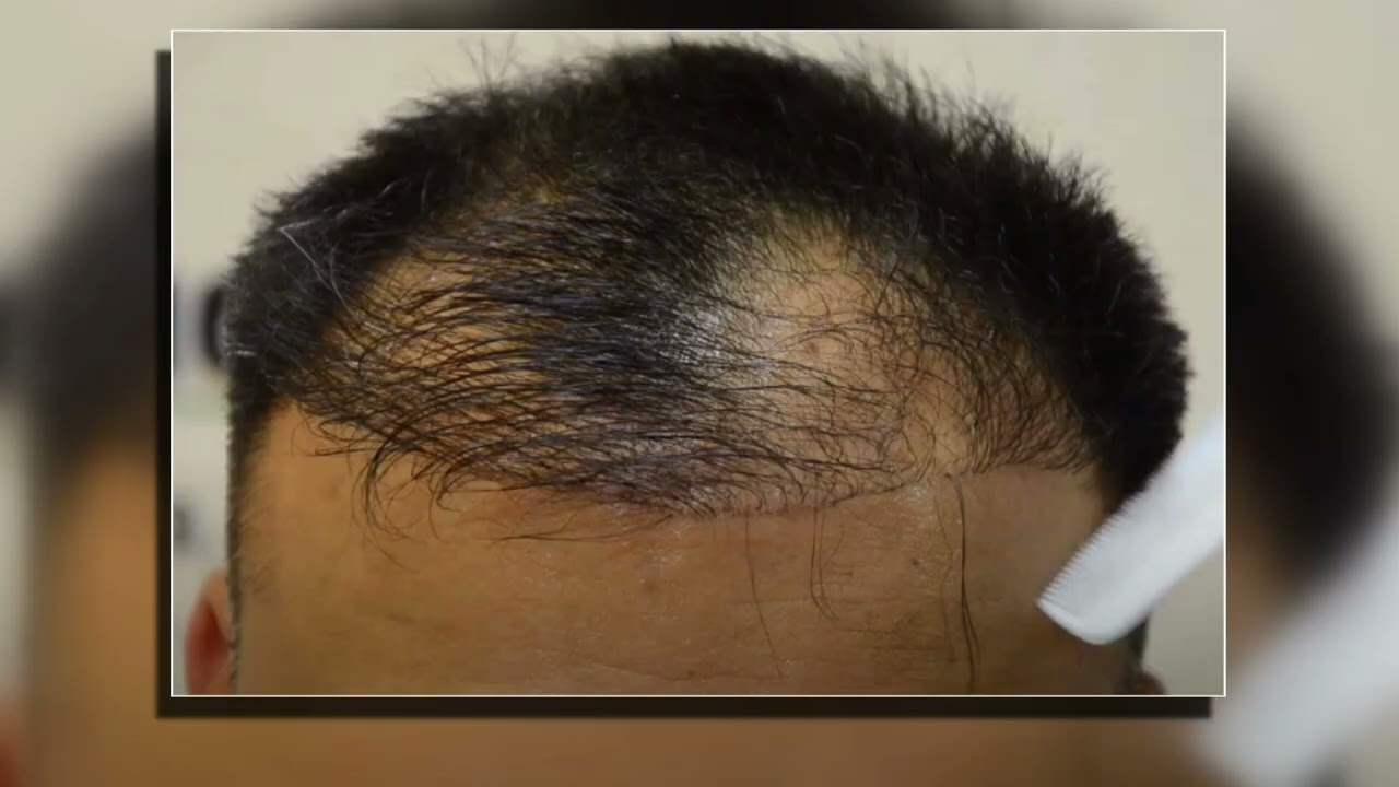 Başarısız Saç ekimi ! @ilhanserdaroglu2179