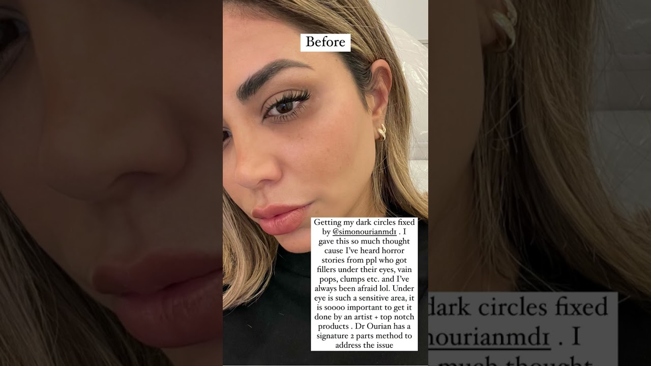 Under Eye Dark Circles Removal with Before and After Pics