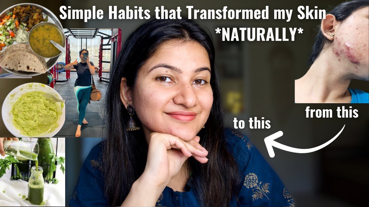 How I Cured My Severe Adult Acne & Fixed My Skin Naturally | Do these 10 things NOW!