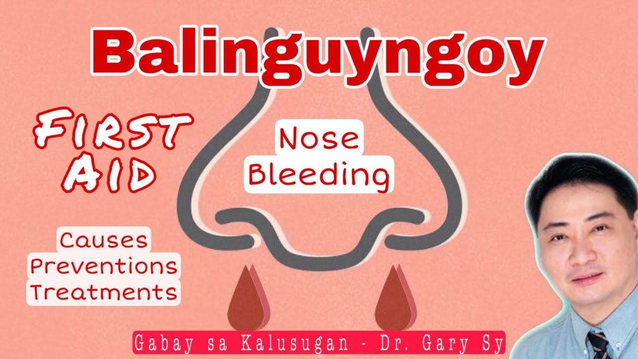 Balinguyngoy: Nose Bleeding (Epistaxis) - Dr. Gary Sy