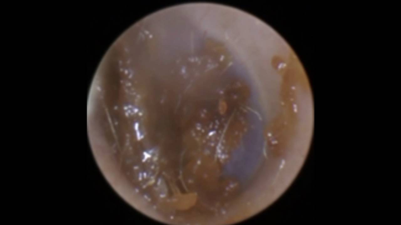Endoscopic Ear Wax Removal Leicester - Mr Neel Raithatha (The Hear Clinic)