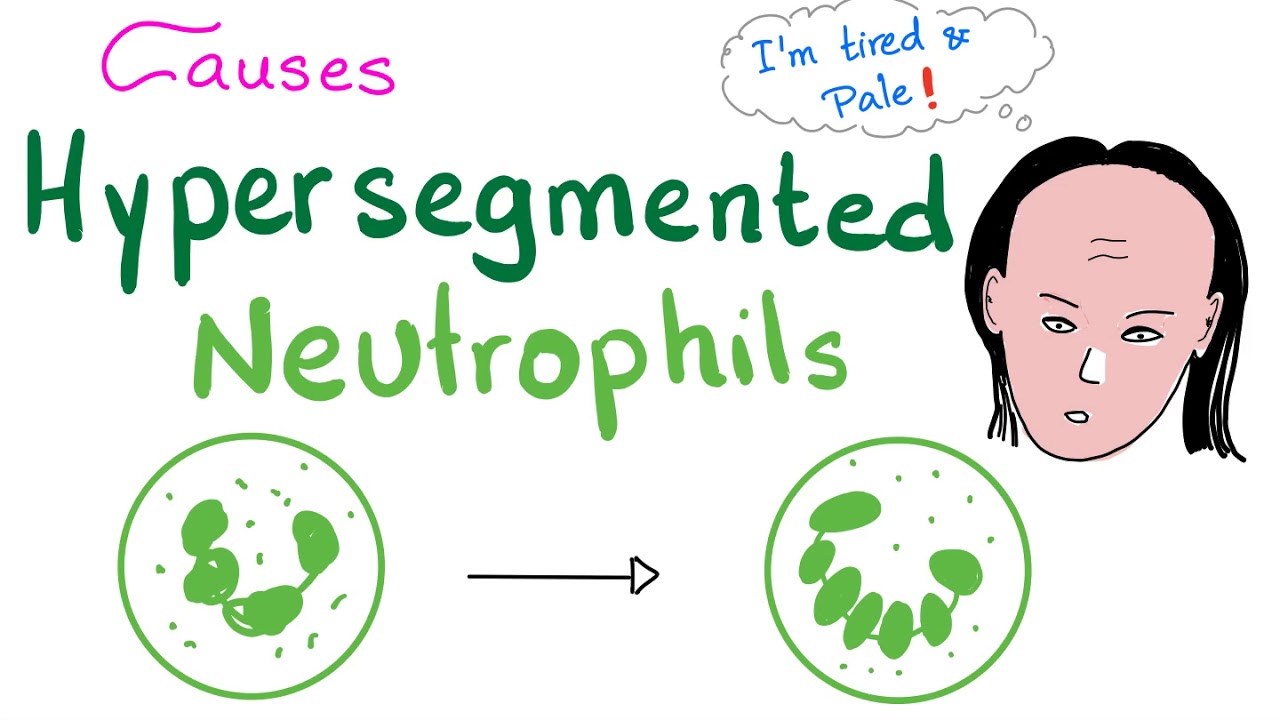 Hypersegmented Neutrophils | Anemia