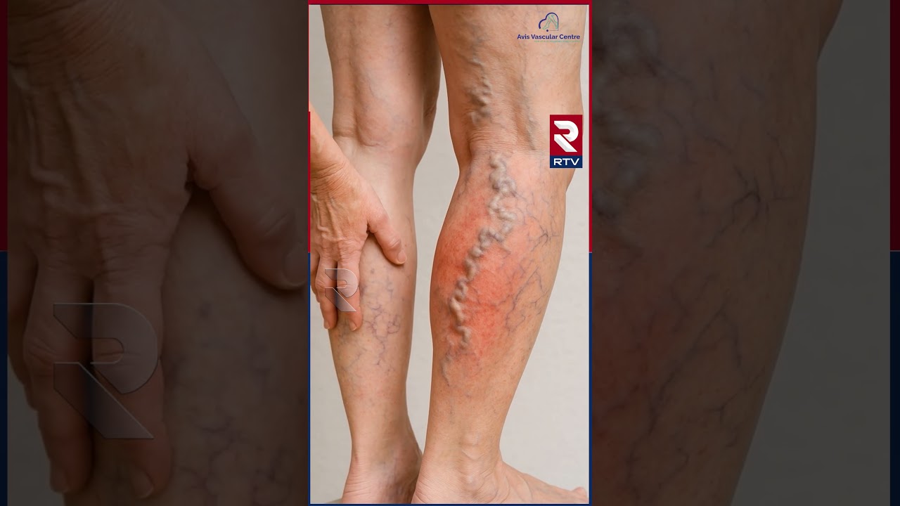 Avis Vascular Centre | Non Surgical Treatment | Best Varicose Veins Treatmen𝐭 | Avis Hospitals | RTV