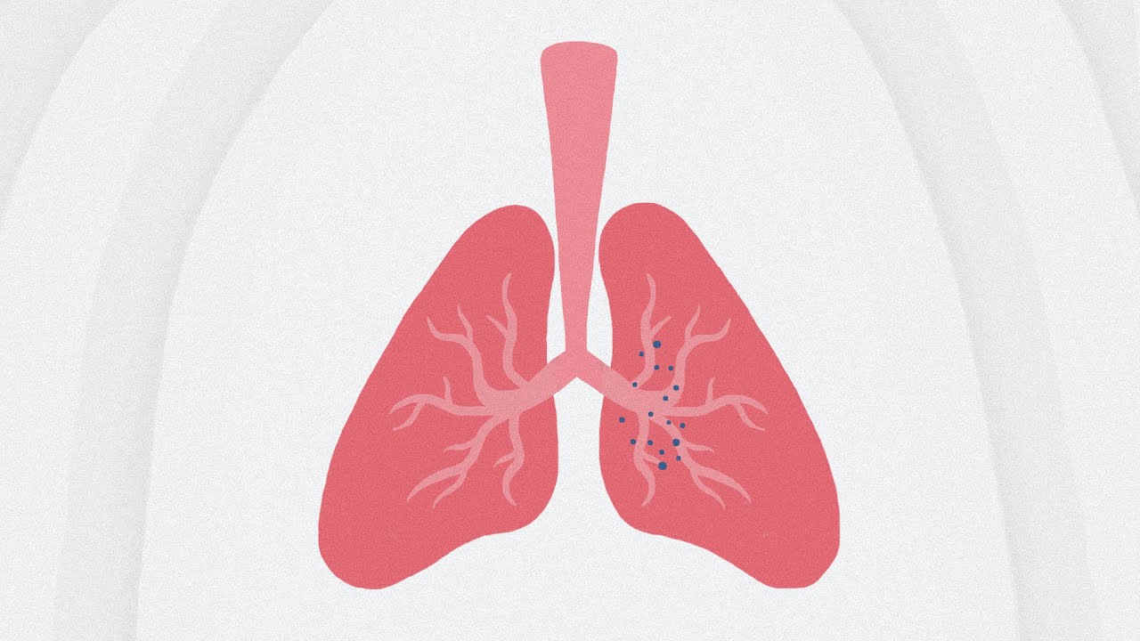 The Double Battle of Covid-19 Related Pneumonia