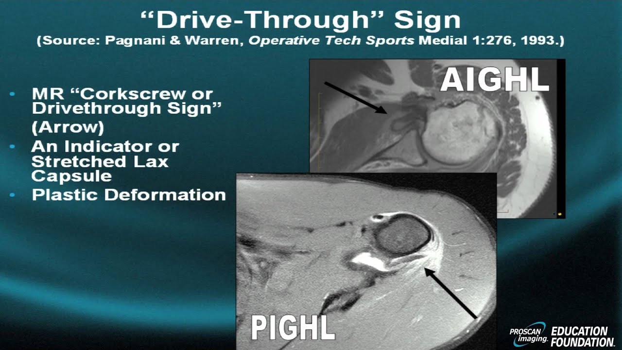 Shoulder MRI: Instability, Part VI
