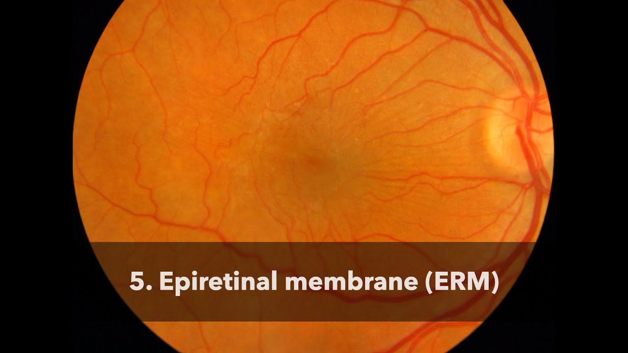 Epiretinal Membrane (ERM)