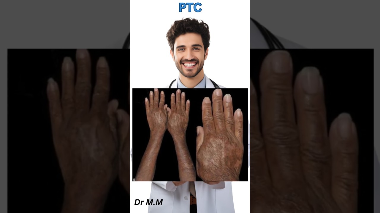 Porphyria Cutanea Tarda | Skin Signs You Shouldn&rsquo;t Ignore!
