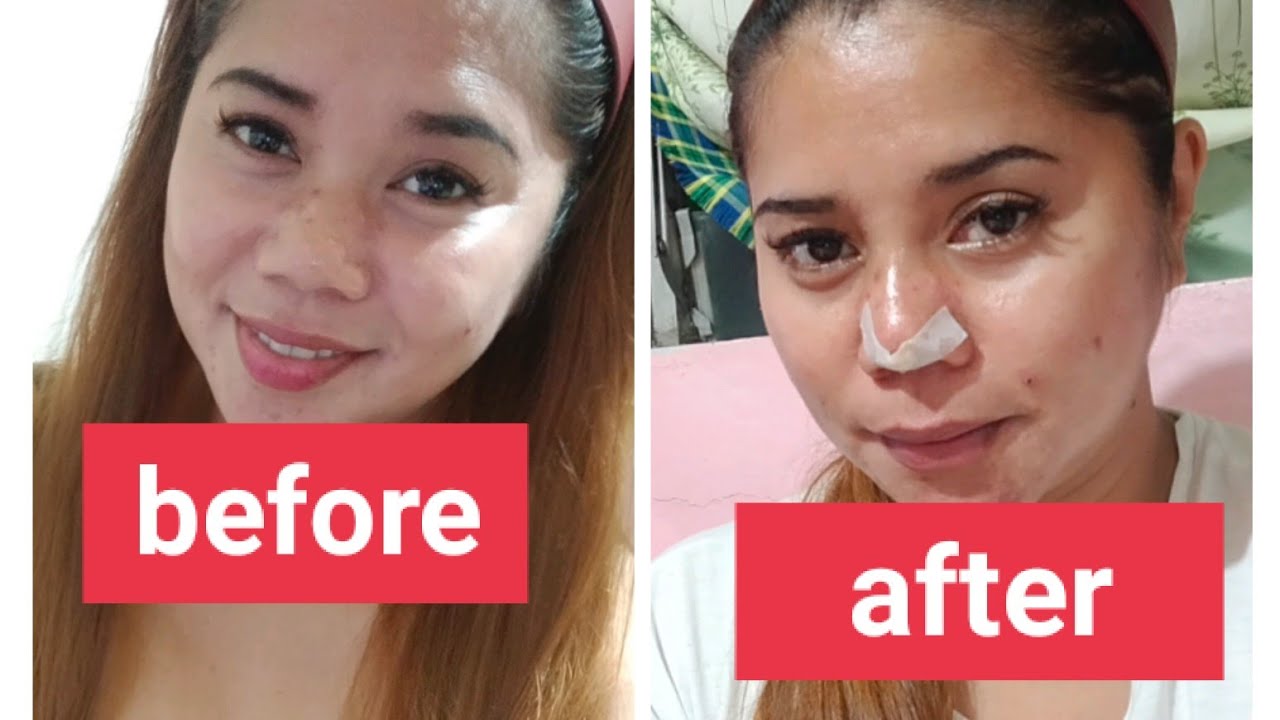 nag pa Retoke ako ng nose by Hiko Thread nose lift enhance your beauty thank you Pinkwork