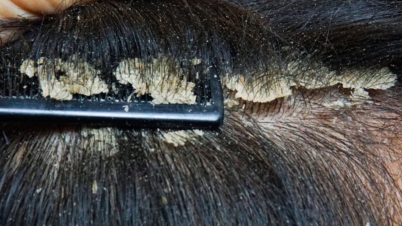 ASMR Satisfying Dandruff Treatment & Scalp Check #0008