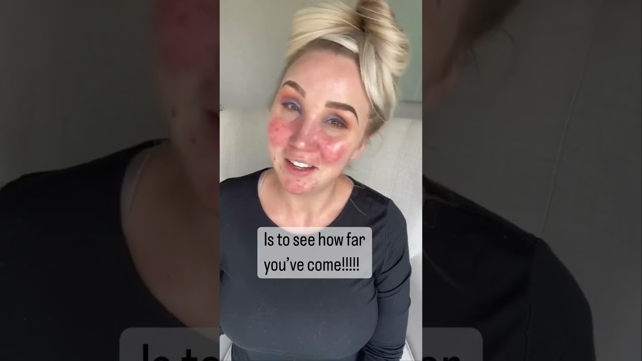 My skin transformation! 😭 Grateful I finally found a solution that works! #rosacea #adultacne