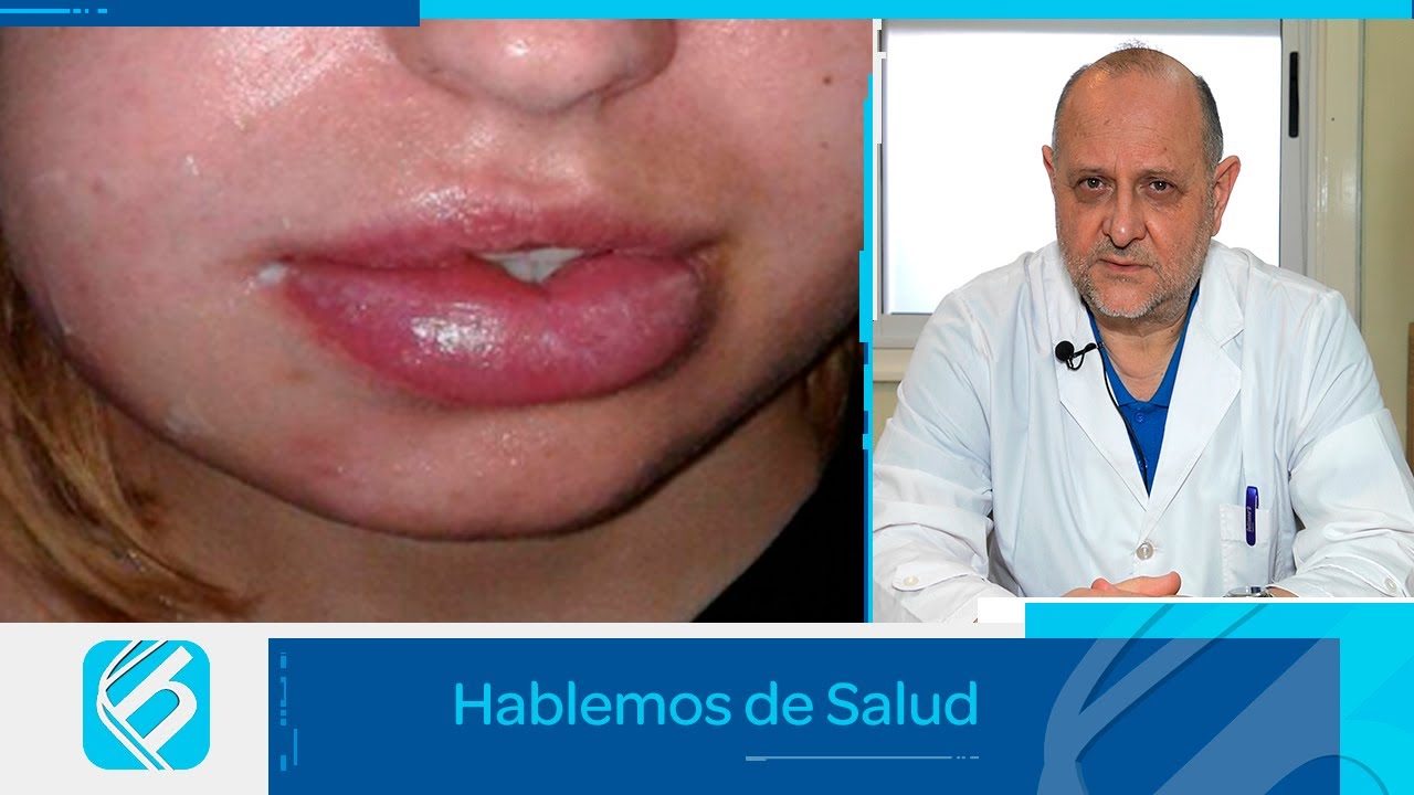 Angioedema Herditario