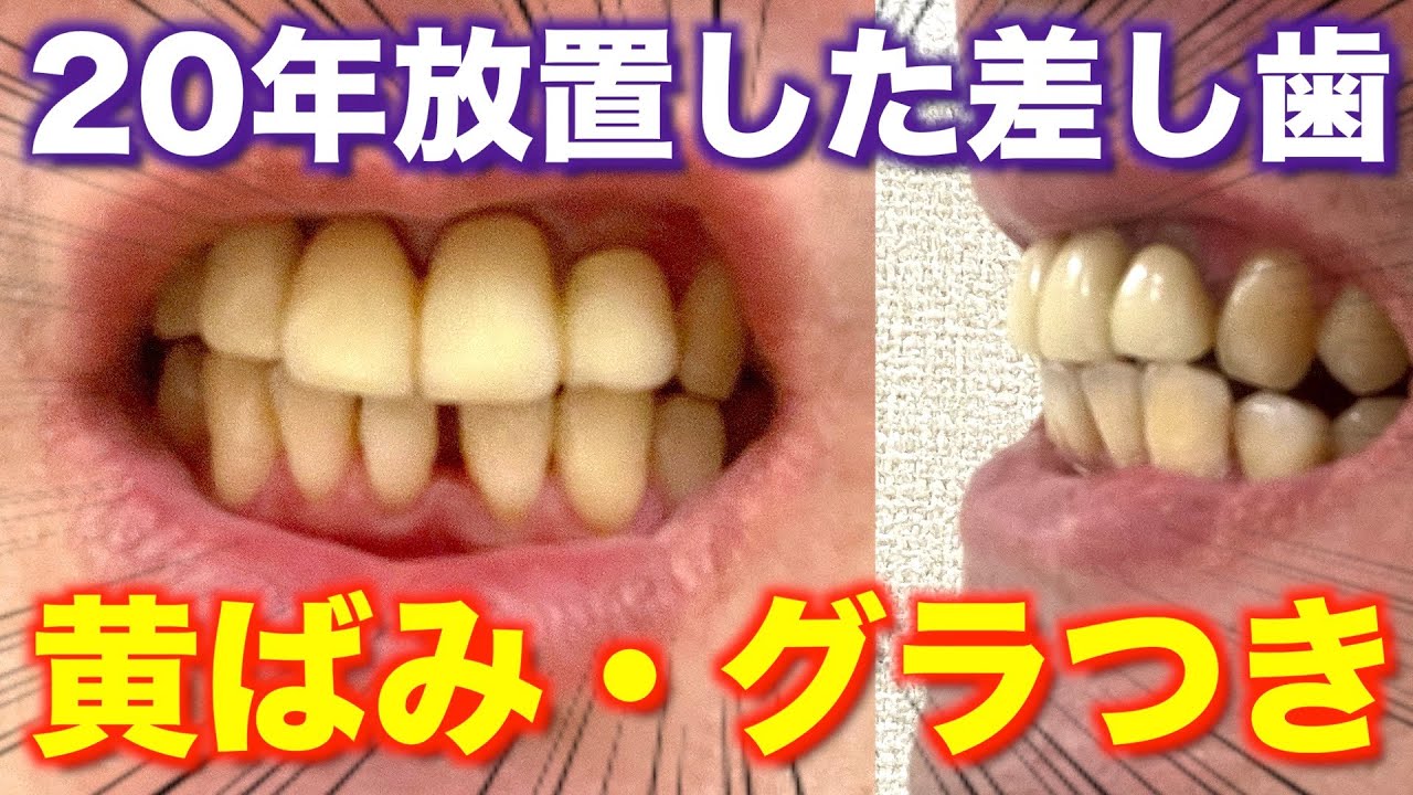 【前歯のブリッジ交換】20年間放置した差し歯の状態確認。黄ばみ・グラつきなど気になるポイントのカウンセリング。