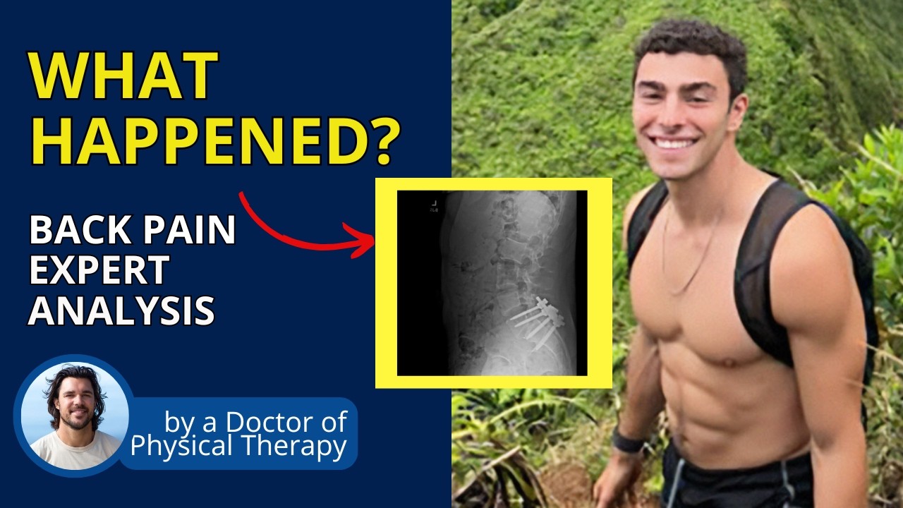 Luigi Mangione's Spine - A Back Pain Expert Analysis