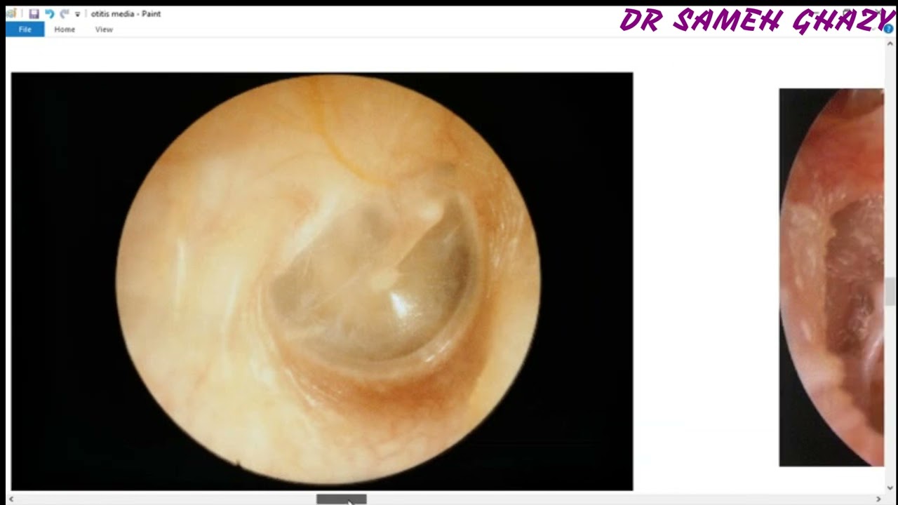 ENT 15 : otitis media ( acute and chronic types ) DR SAMEH GHAZY