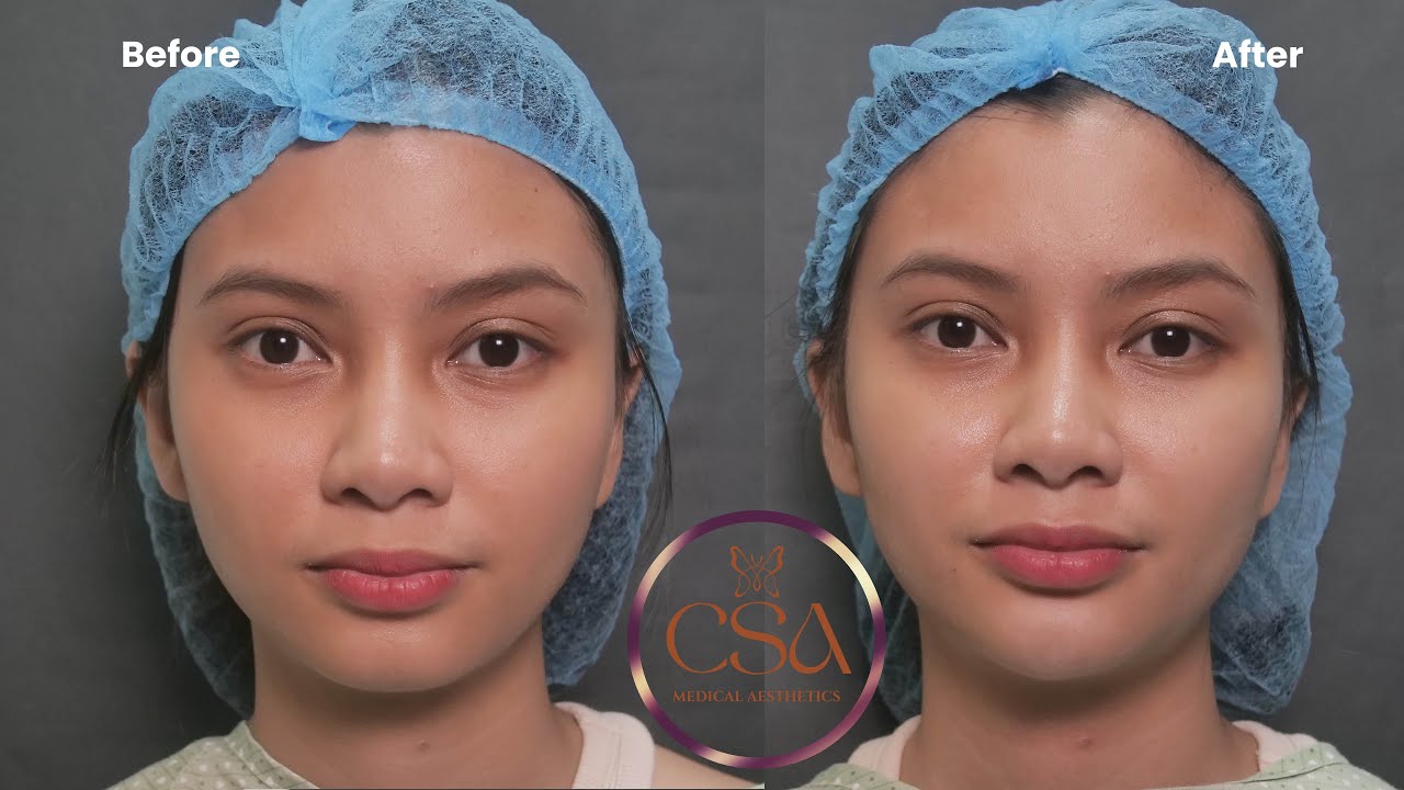 Instant V-contour: how to achieve ‘Hugis Bigas’ | Contessa Salvador-Alapag
