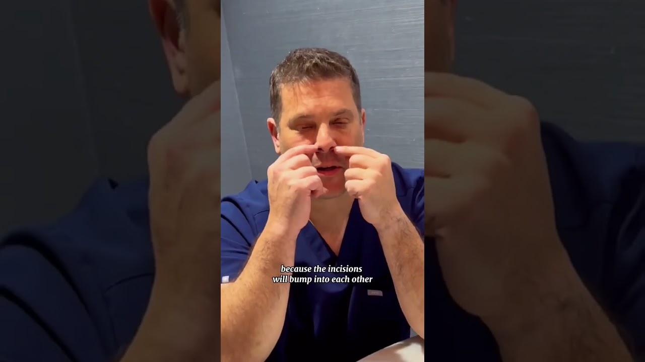 Dr. Rich On A Lip Lift Tip #lips #lip #liplift #nostrils #nosejob