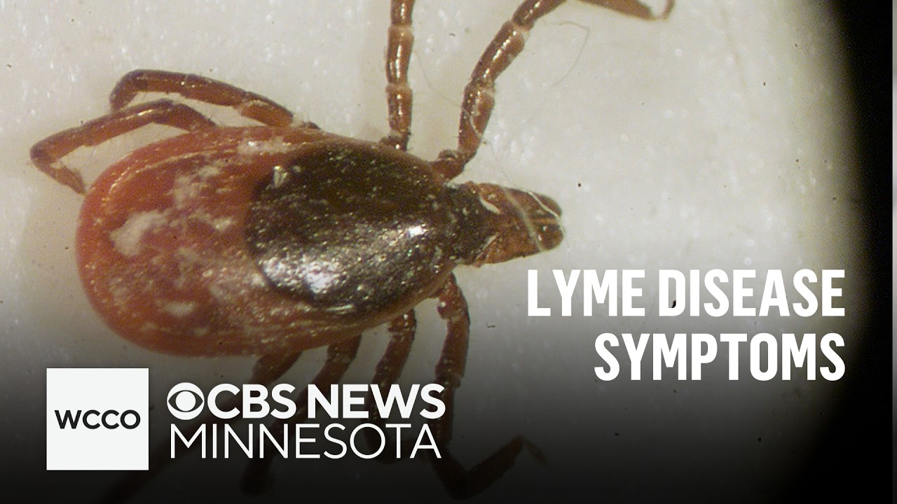 Woman with chronic Lyme disease shares misdiagnosis story | Talking Points