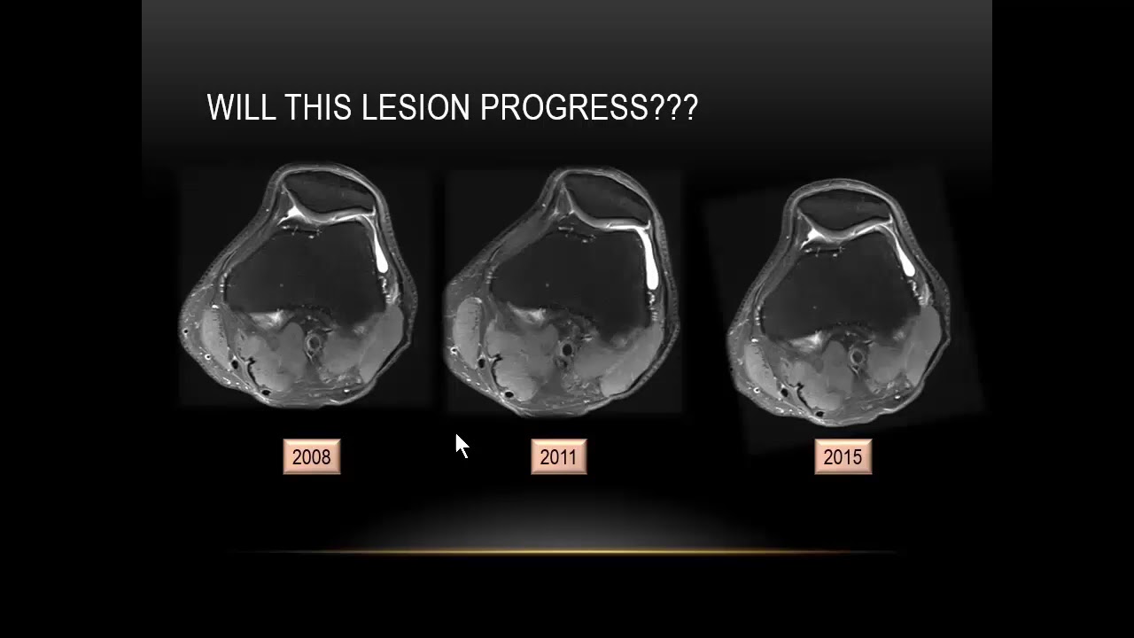 ISMRM MR Academy - Cartilage Mapping Techniques & Applications