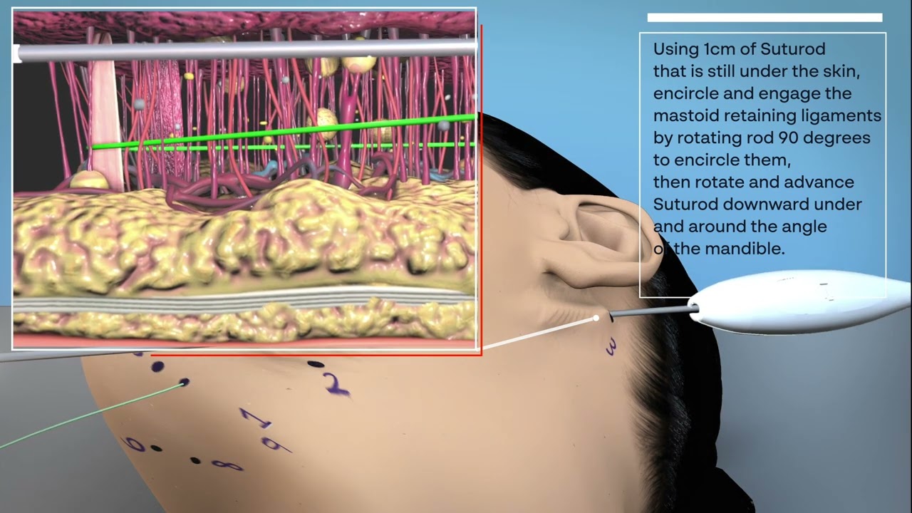 MyEllevate® Procedure Overview Video