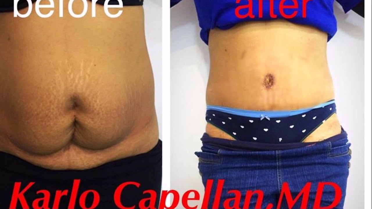 Makati's Finest: Best Tummy Tuck and Butt Implant in Town