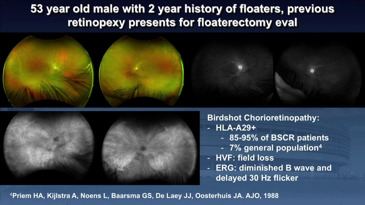 SYM39 04   White Dot Syndromes A Systematic Approach to Diagnosis   The White Dot Syndromes Definiti