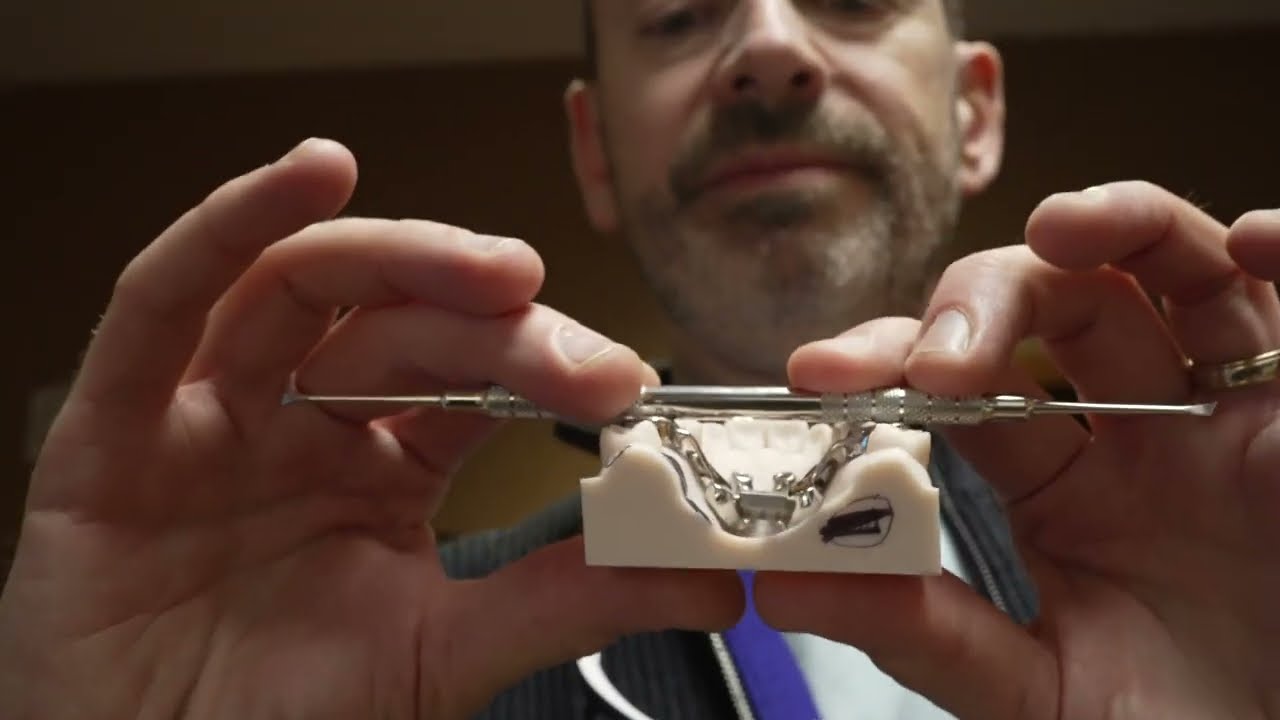 Could This Help Prevent MARPE Asymmetry?