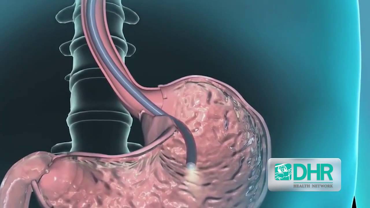 Qué Esperar • Endoscopía