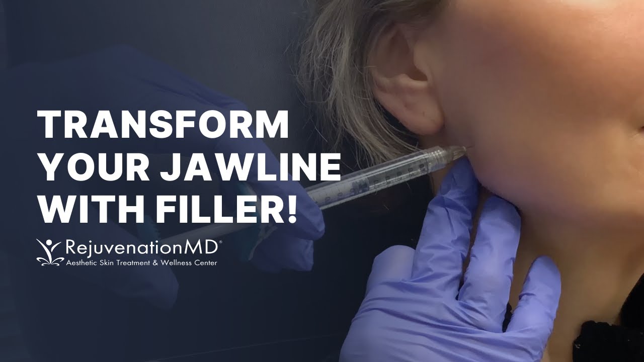 Define Your Jawline with Juvederm Volux