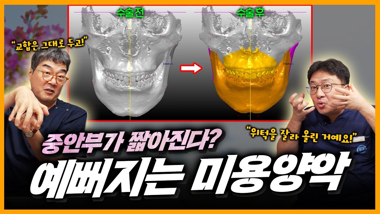 긴 얼굴과 비대칭 얼굴에 미용양악을 했더니 중안부가 이렇게 짧아진다고요?
