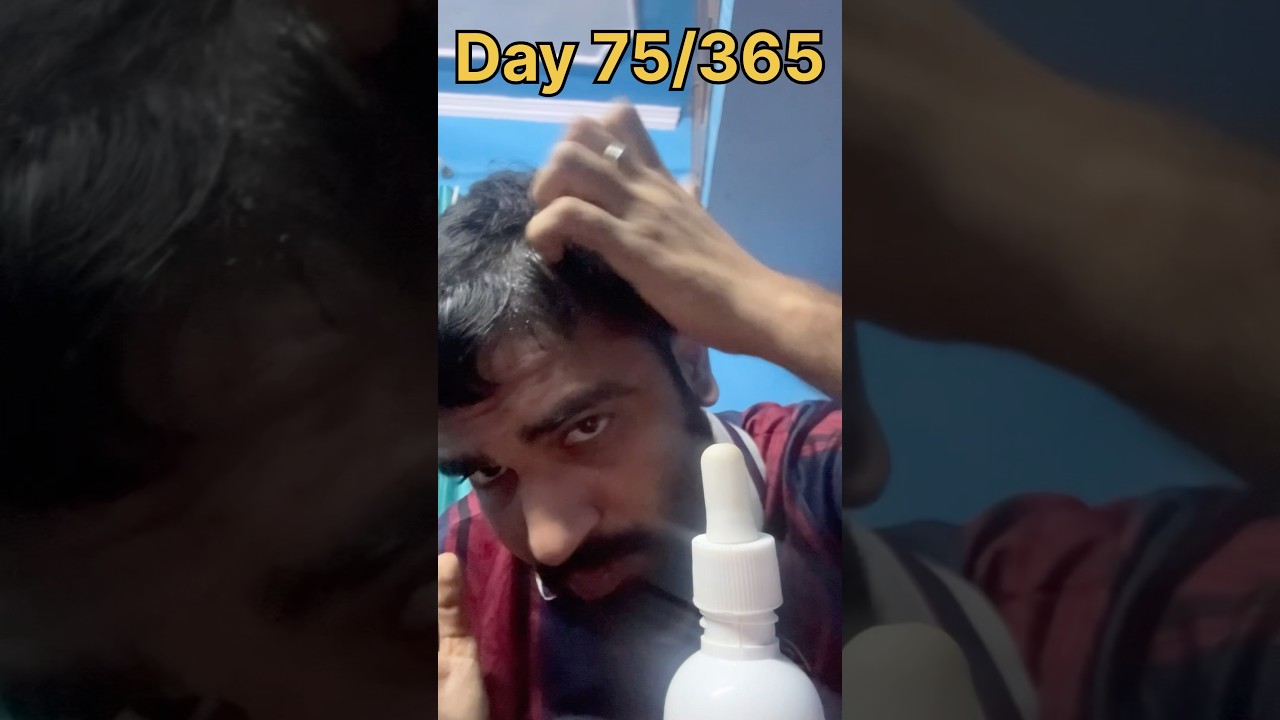 Day 75/365 – Starting my Minoxidil journey. Let’s see the results  