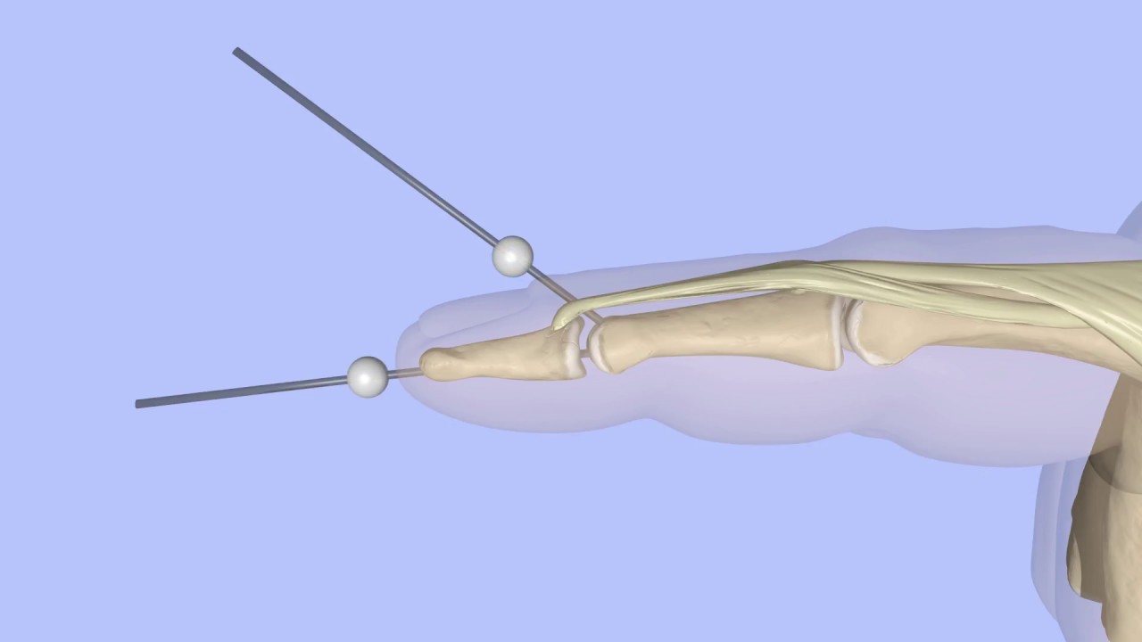 Extension Block Pinning of a Bony Mallet Finger