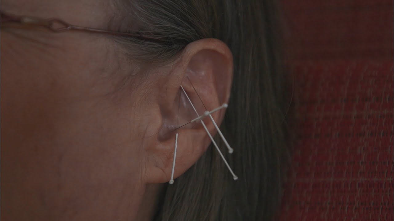 NADA - Group Acupuncture Therapy