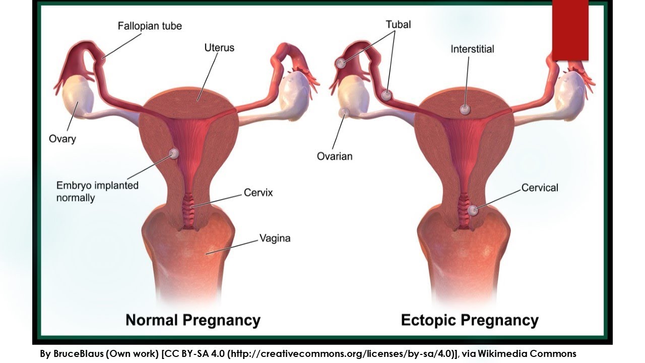 RCOG Guideline Diagnosis and Management of Ectopic Pregnancy No.21