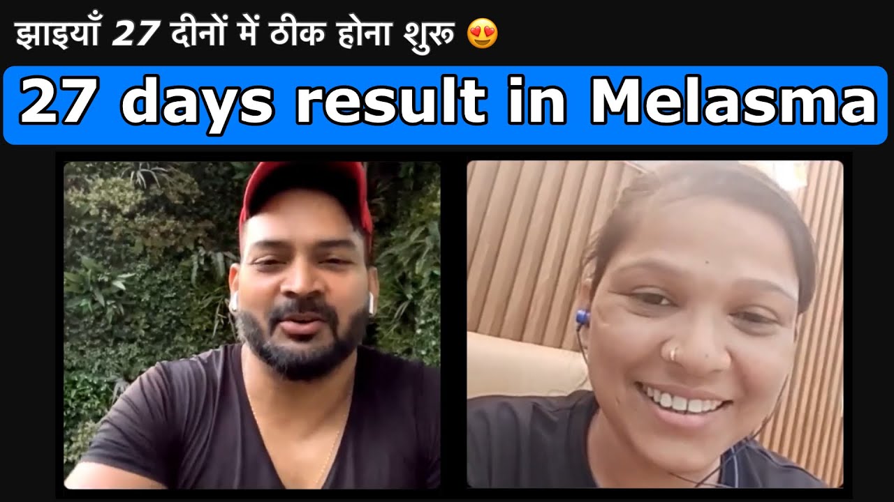 27 days result in Melasma. झाइयाँ 27 दीनों में ठीक होना शुरू 😍