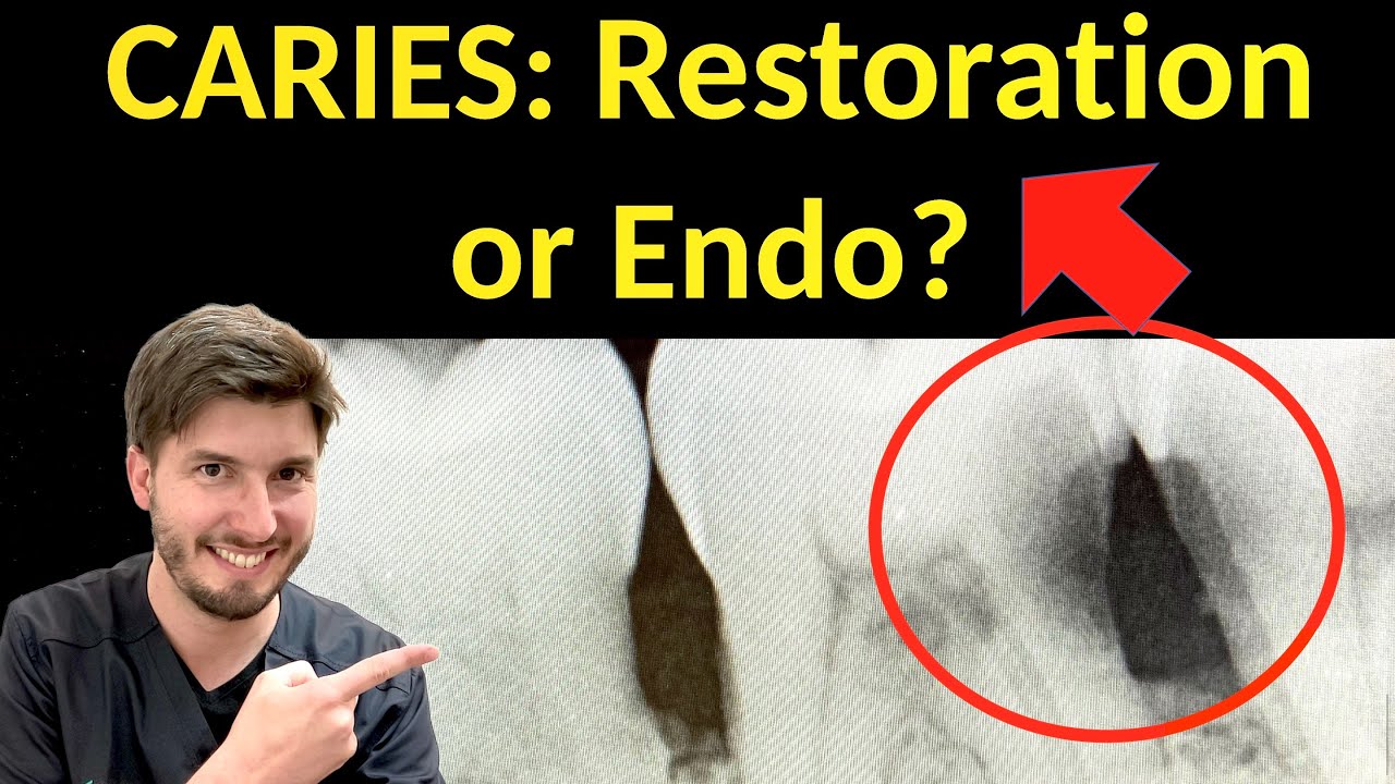 Cavity Restoration or Root Canal Treatment Process? Save of a tooth after Deep Caries Removal: ICDAS