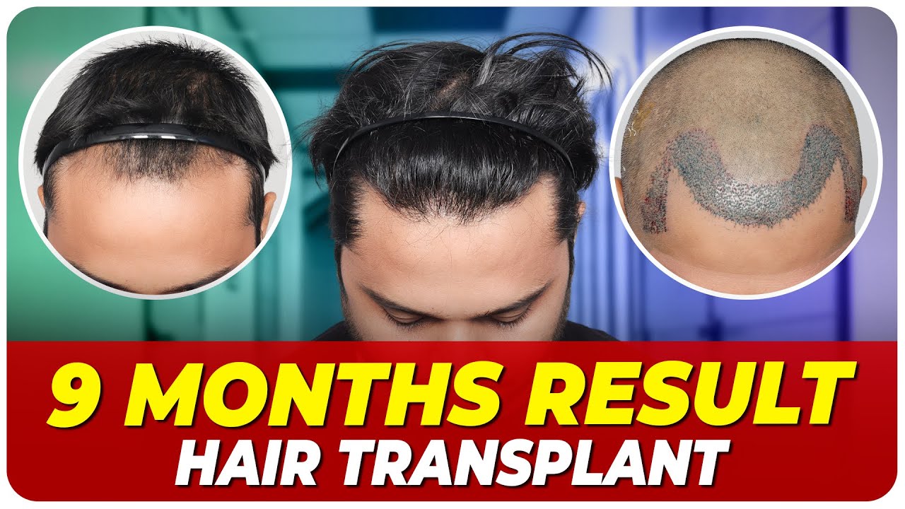 Hair Transplant Time Lapse | Step by Step Hair Transplant Surgery Time Lapse