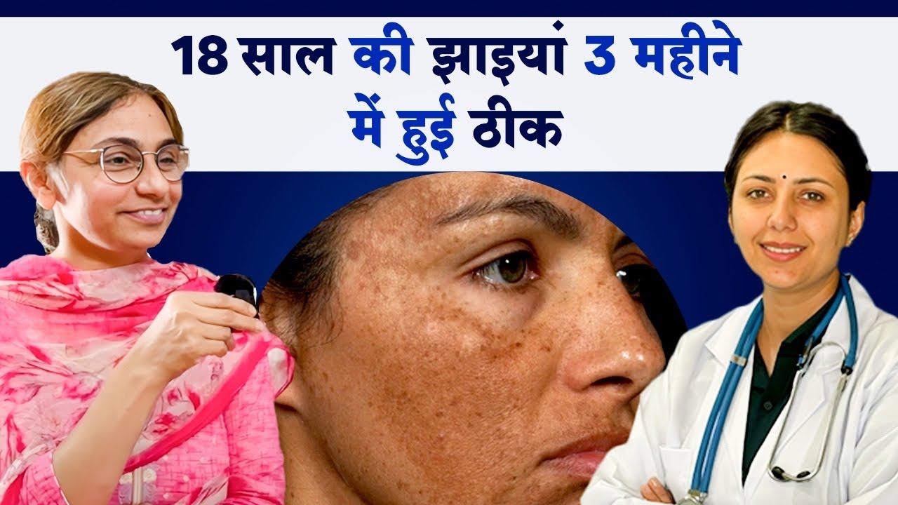 झाइयों को किया 100% ठीक 🔥 | Hyperpigmentation Melasma | Dr. Upasana Vohra #pigmentation #clearskin