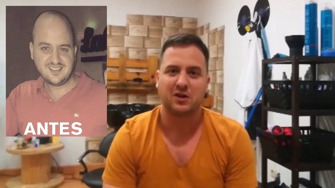 Trasplante capilar en Turquía: Mi experiencia real | Capilclinic