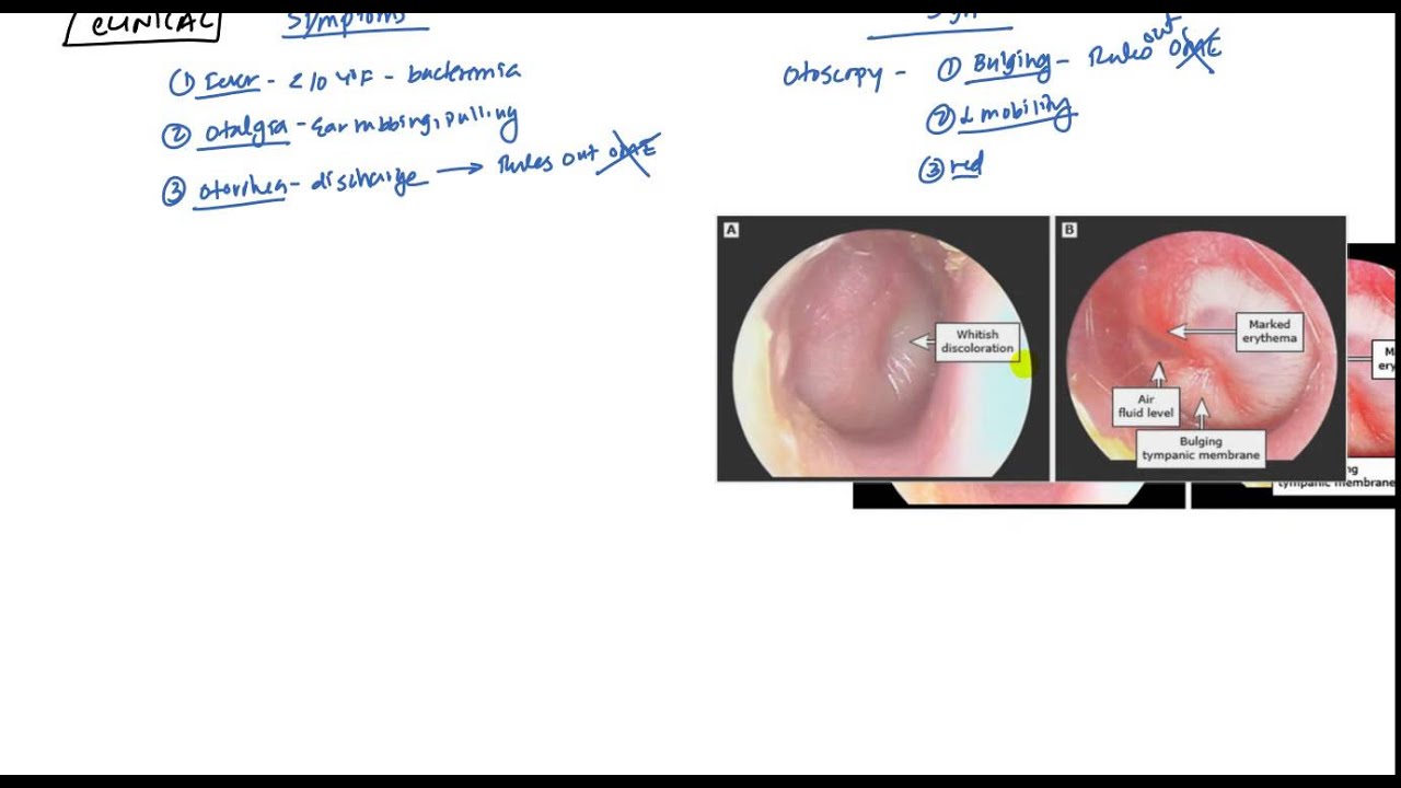 Acute Otitis Media and Otitis Media with Effusion for USMLE Step 2