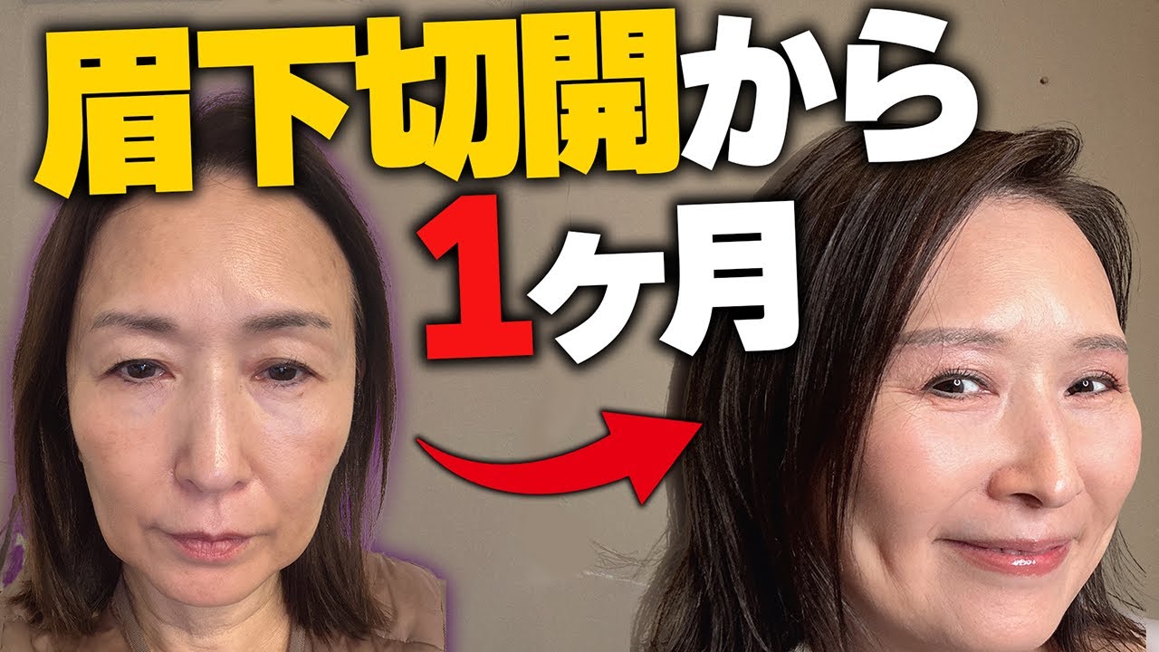 おかげ様で眉下切開手術から1ヶ月経ちました！