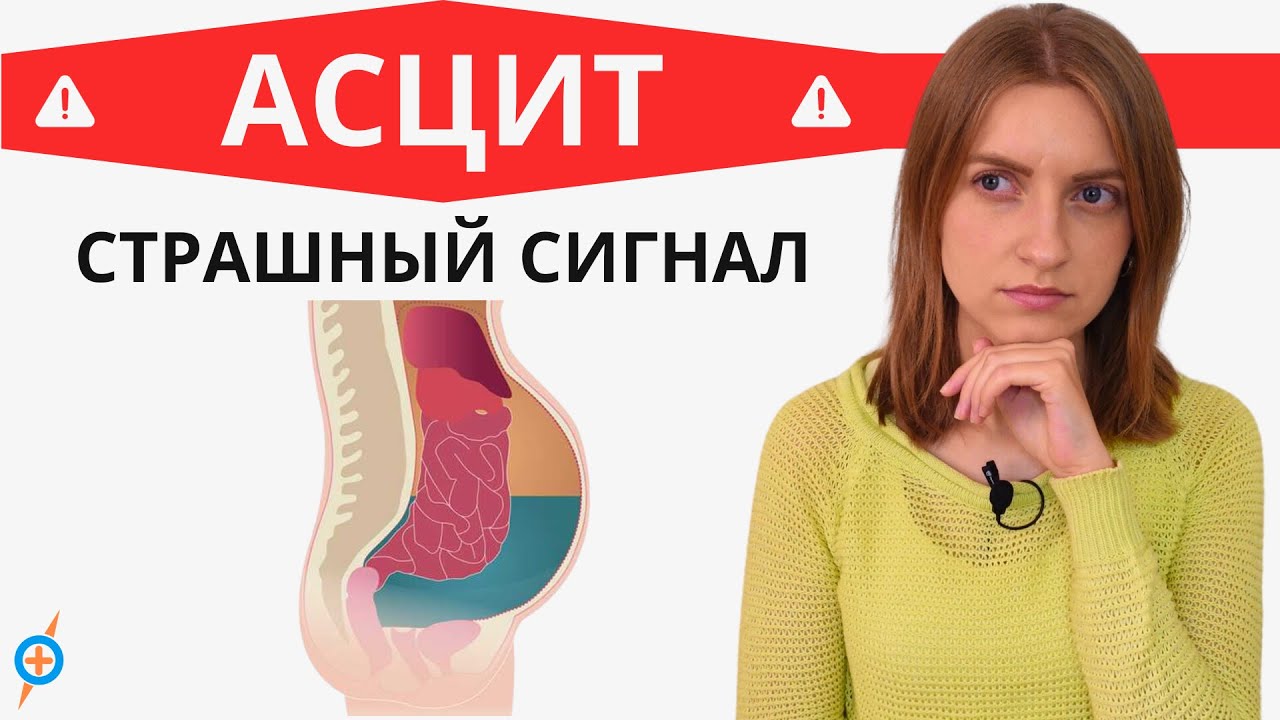 Какие болезни ведут к АСЦИТУ (водянке живота)? | Mednavigator.ru