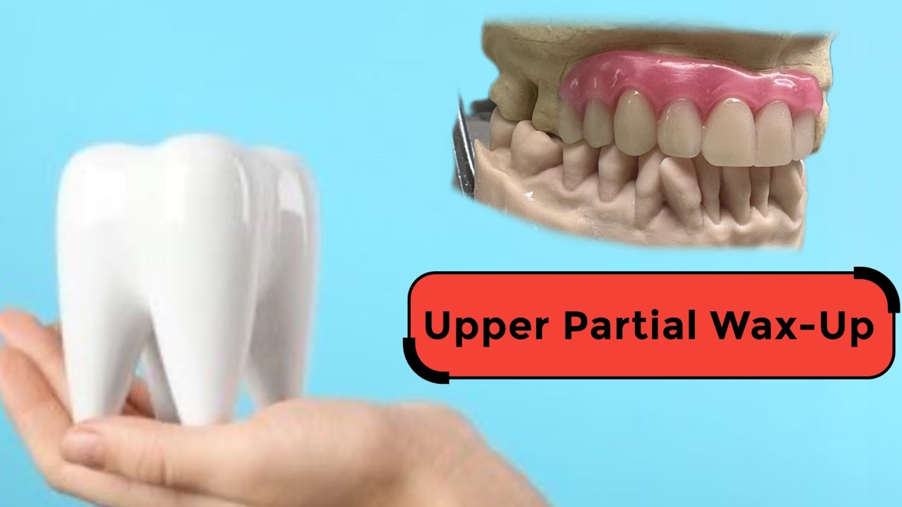 Upper Partial Done Right? 