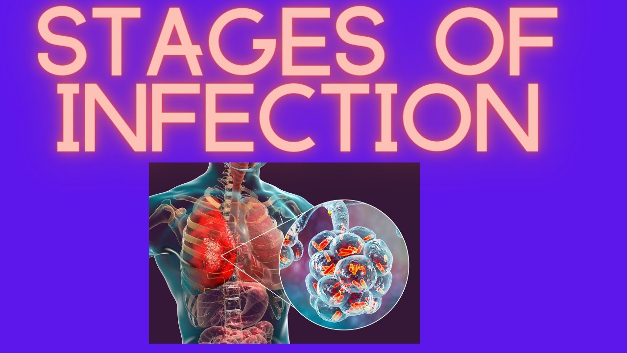 5 Stages of Infection - using COVID 19 as a case example