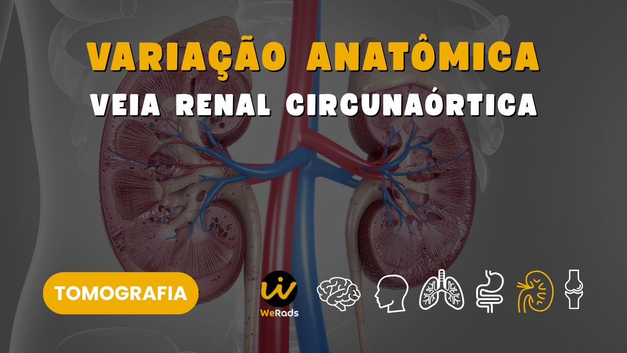Veia Renal Circuna&oacute;rtica: Varia&ccedil;&atilde;o Anat&ocirc;mica na Tomografia