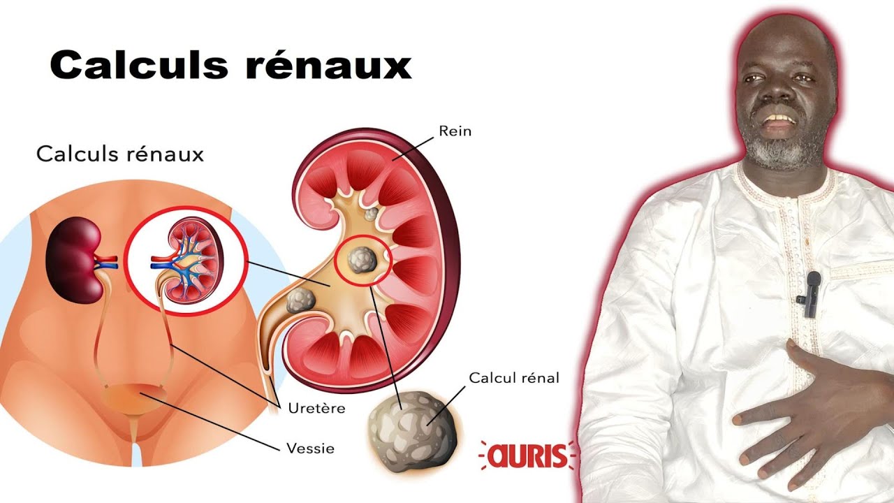 👨‍⚕️Calculs rénaux #1: ( Causes et Symptômes  ) - Pr Ousmane Ndiaye - SAMA XALAAT TV